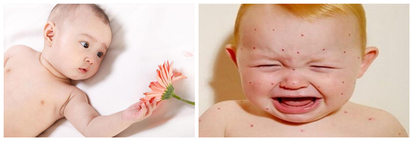 兒童濕疹反反復復,您有在家安裝家用除濕產品嗎?_重復